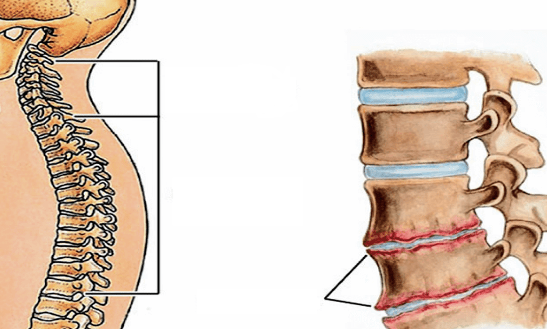 It looks like osteochondrosis of the spine