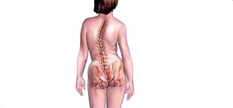 osteochondrosis