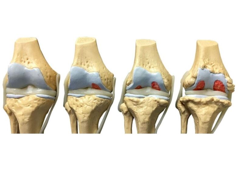 degree of joint arthrosis